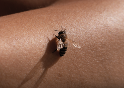How to treat bee stings